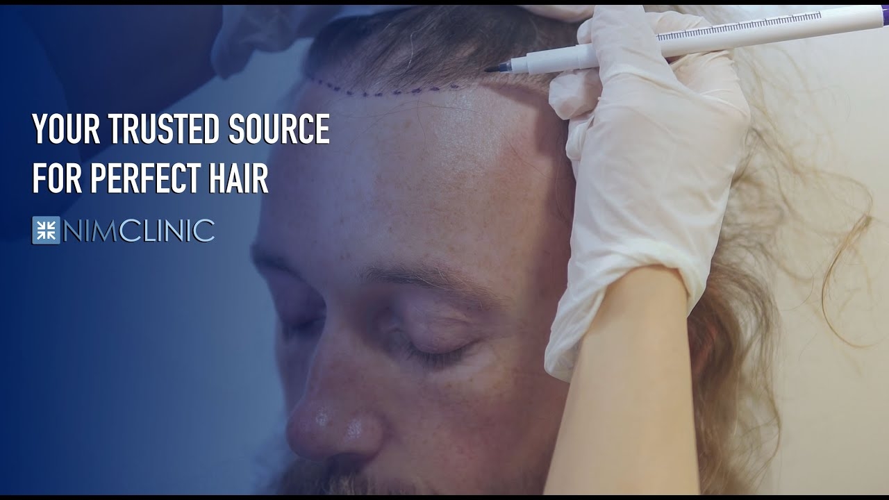 Patient Stories Finding the Best Hair Transplant in Turkey