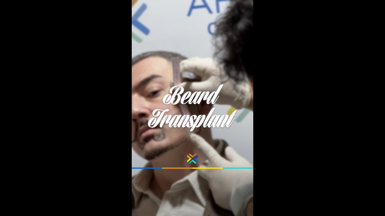 Post Beard Transplantation Interview | #beardtransplant #beardtransformation #beards