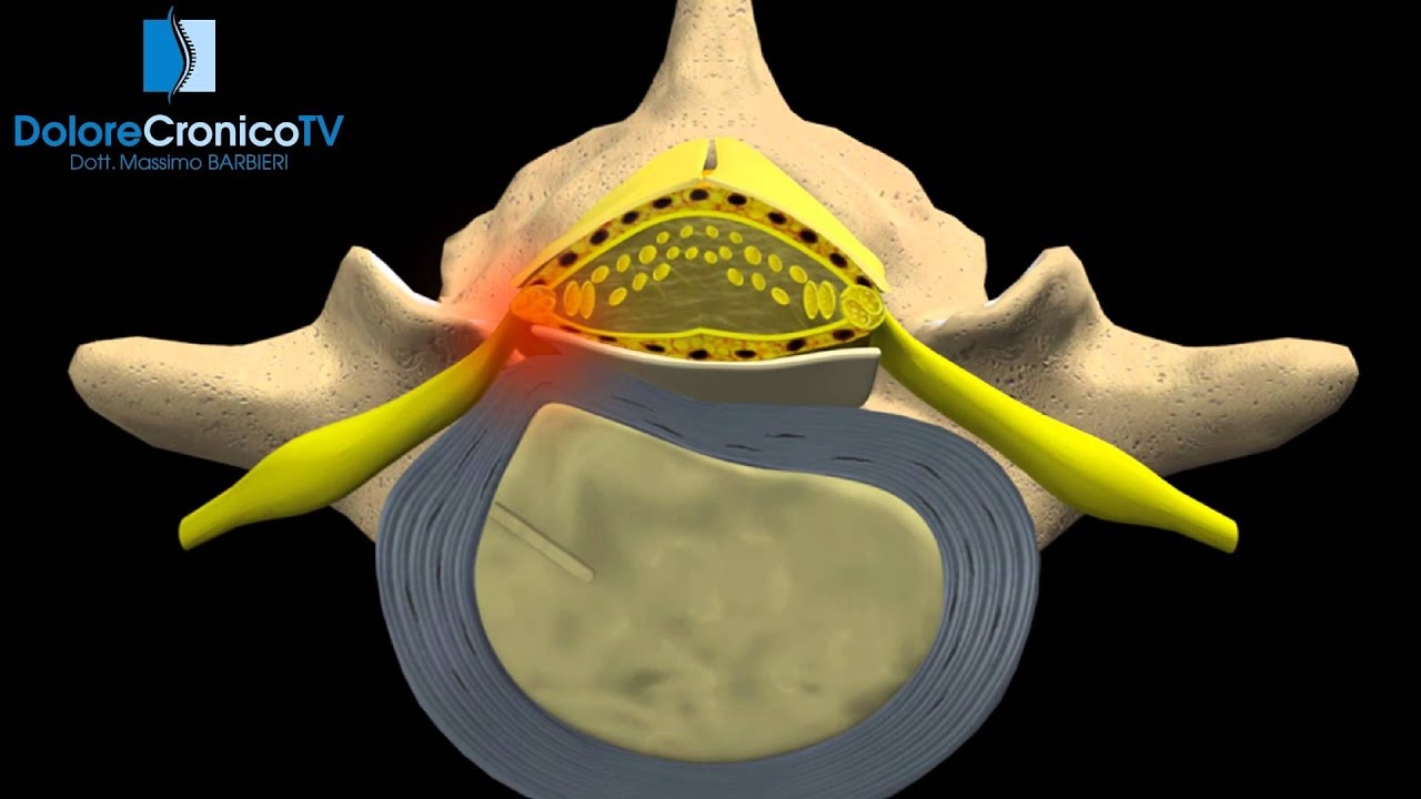 WHAT IS SCIATICA?