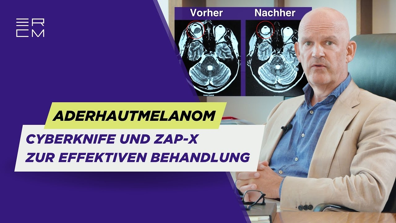 Treat uveal melanoma effectively with CyberKnife & ZAP-X