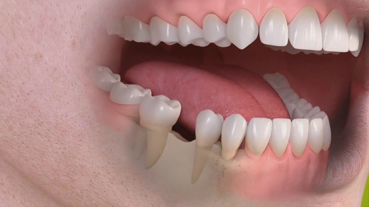 Dental bridge - Albodent