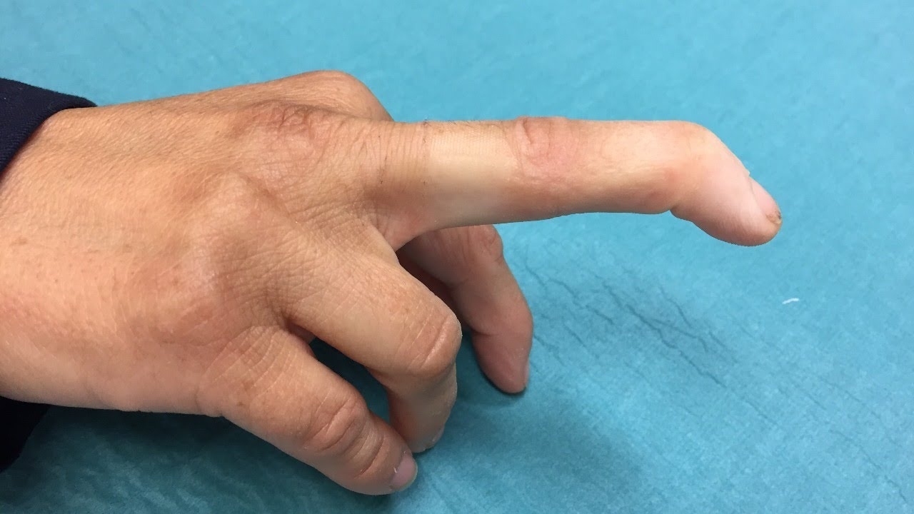 Finger trauma: crushing, chipping, nail injury