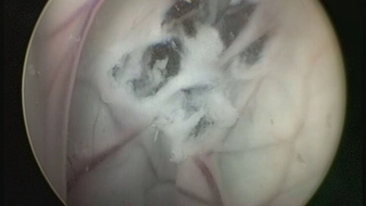 Ventriculocystostomy - Cavum veli interpositi arachnoid cyst - surgical demonstration