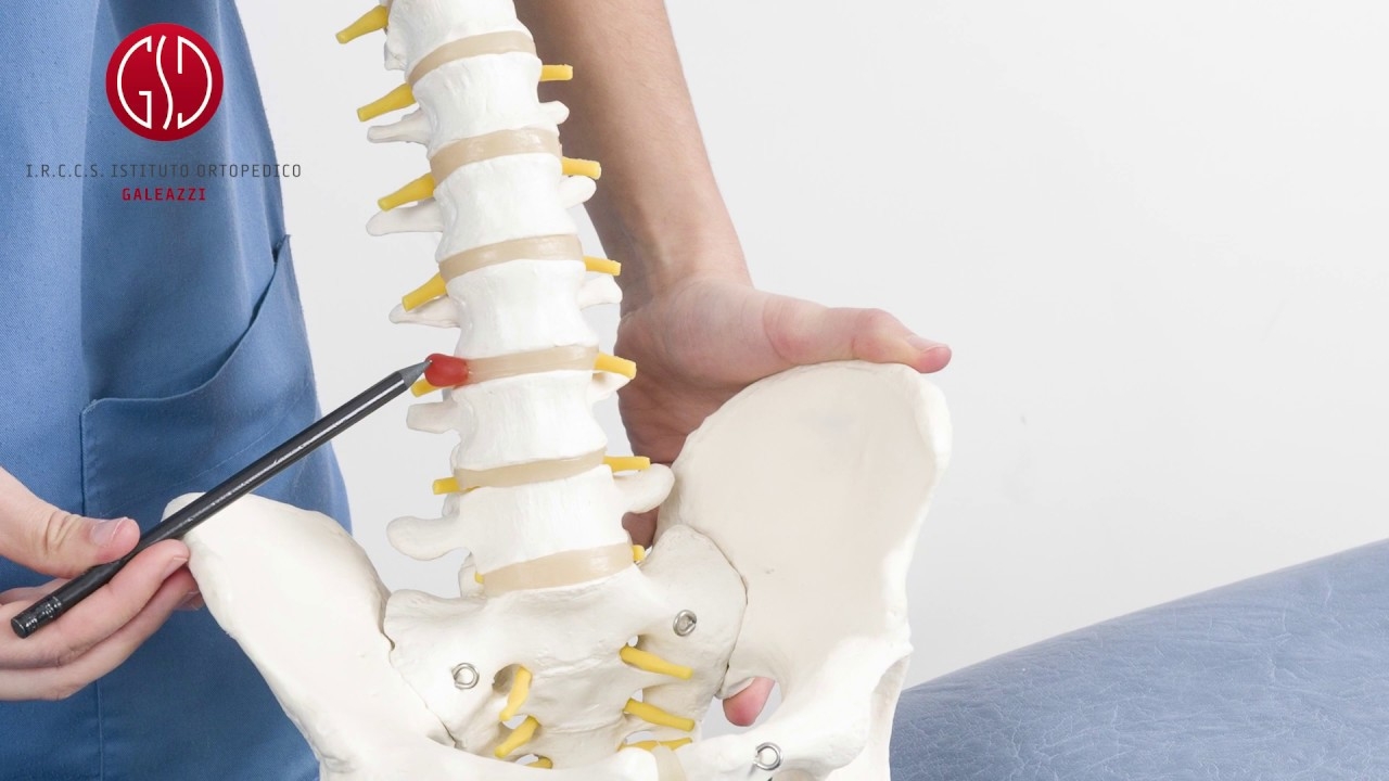 The Expert's Answer - Vertebral Surgery: what is disc herniation