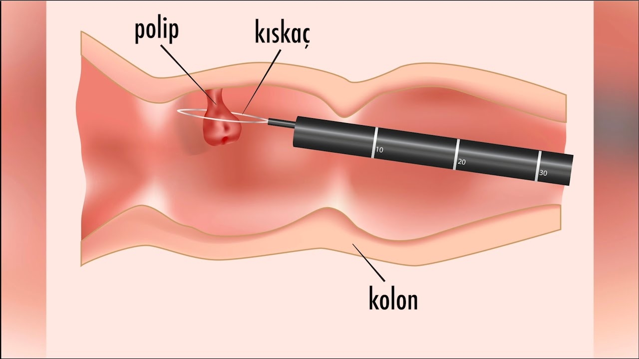 What is a colonoscopy? - Prof. Dr. Alper Yurci (Gastroenterology Uz.)