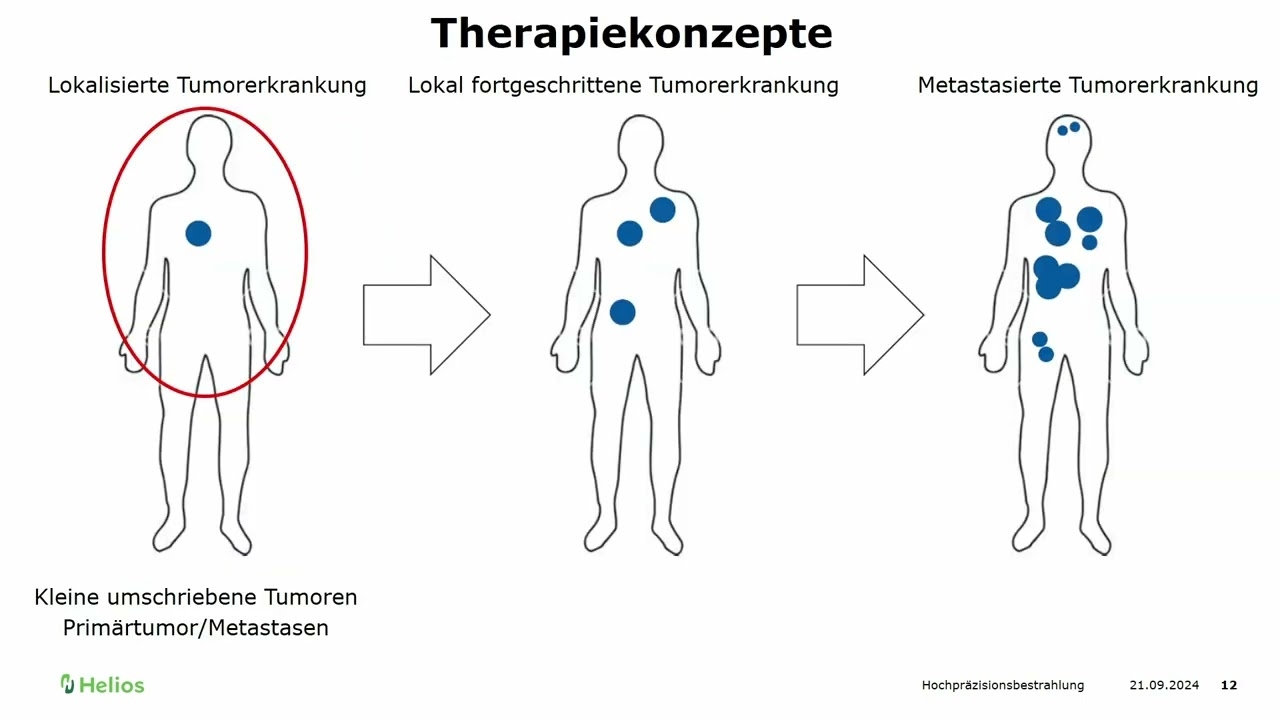 Presentation | High-precision radiation as a possible local tumour therapy