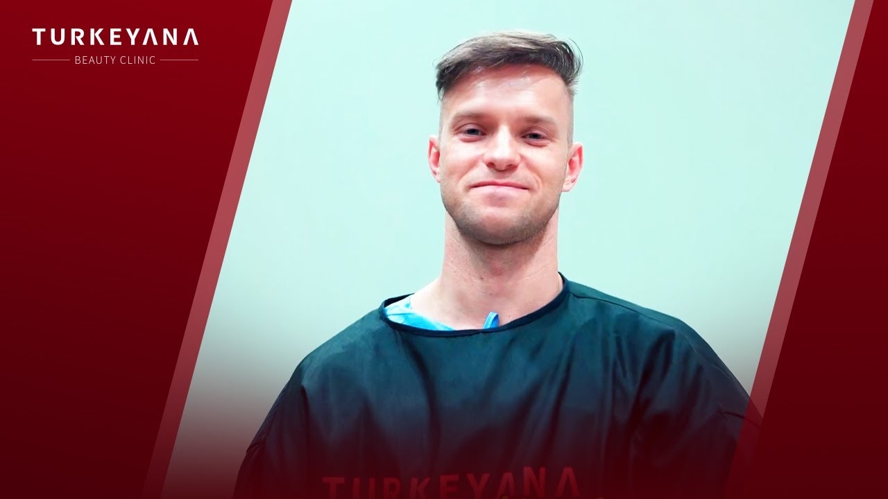 One Year Hair Transplant Results | From USA to Istanbul
