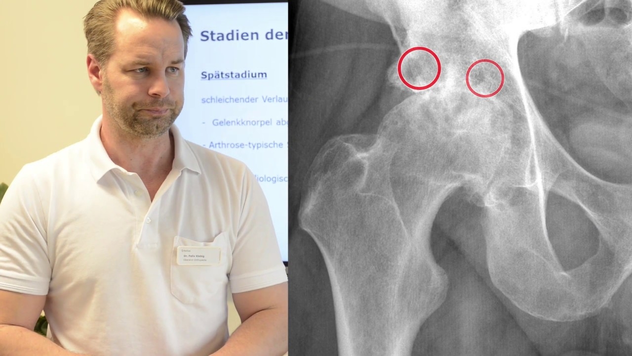 What is osteoarthritis?