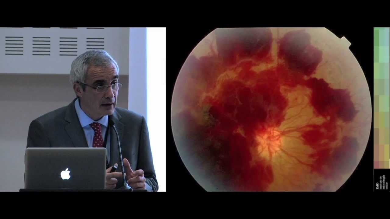 Diabetes and Vision (1) Symptoms and Prevention. Dr. Navarro from IMO Barcelona