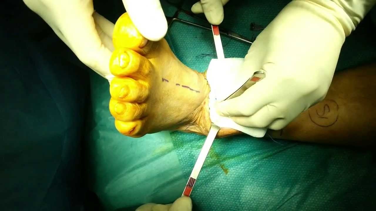 Ankle operation - Dr. Michele Boga