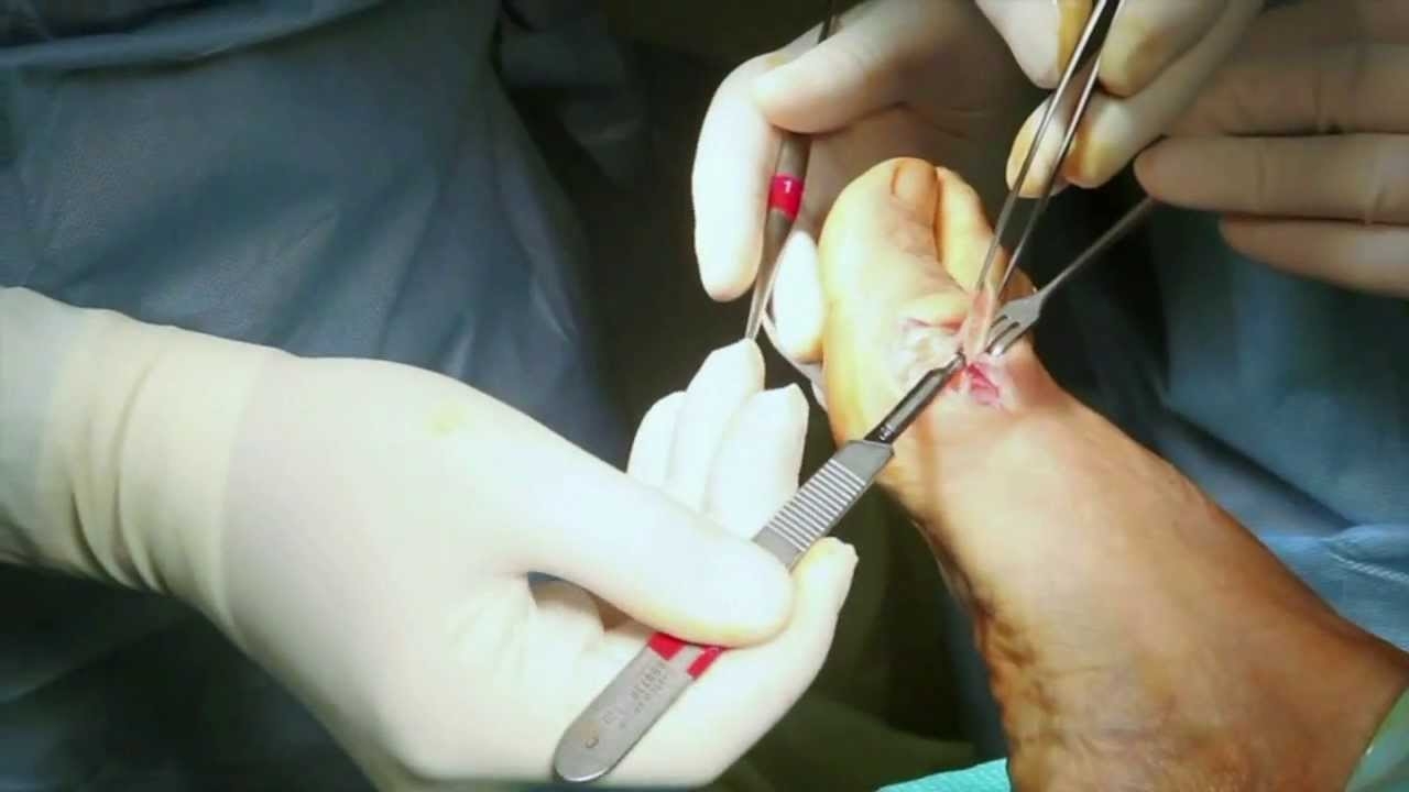 Hallux Valgus operation - Dr. Michele Boga