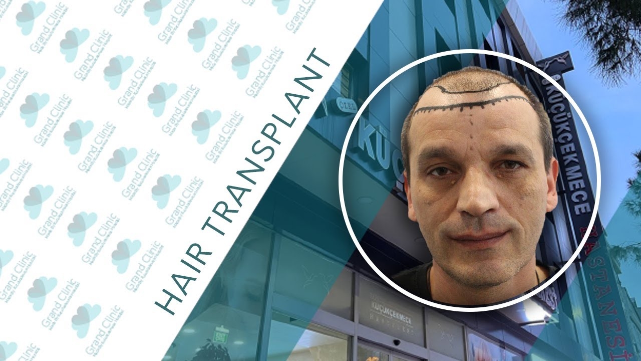 Hair Transplant - Grand Clinic