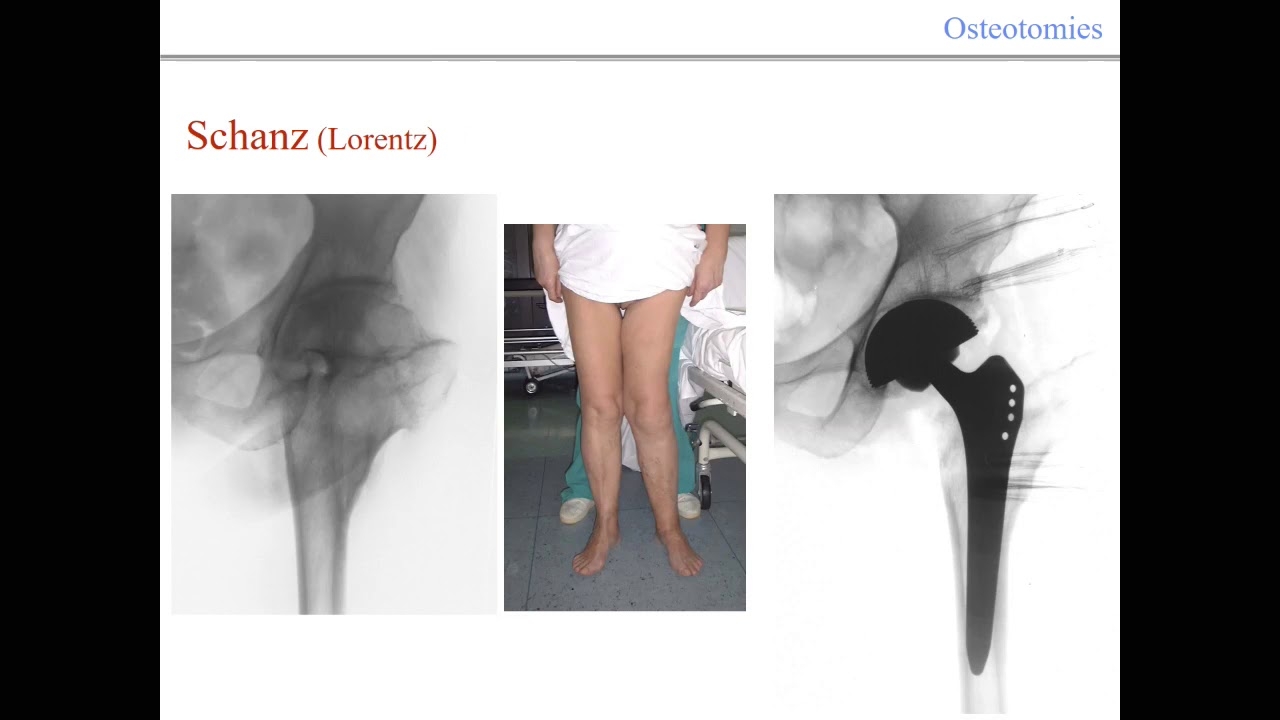 L. Zagra, THA after previous osteotomies, Hip Symposium 2018