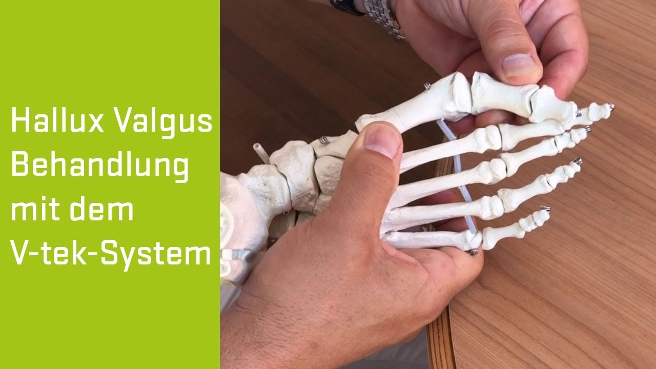 Hallux Valgus - treatment at Döbling Private Hospital