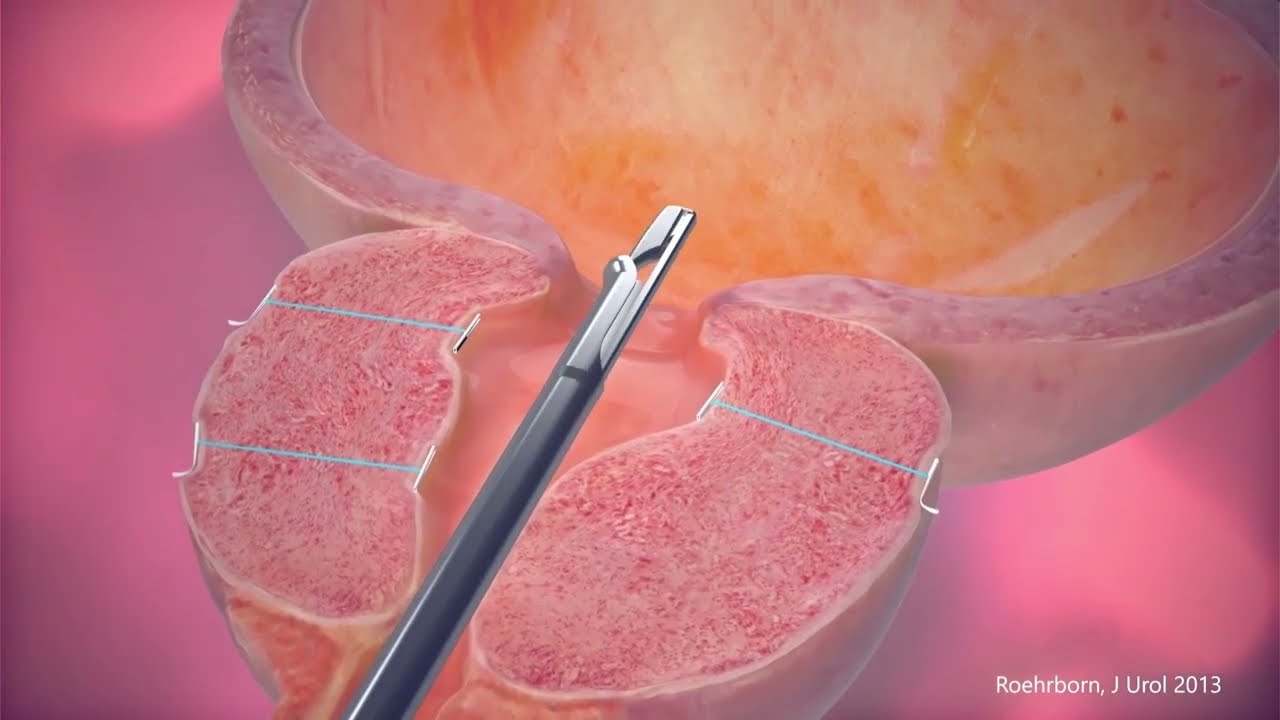 The UroLift System - Animation Video