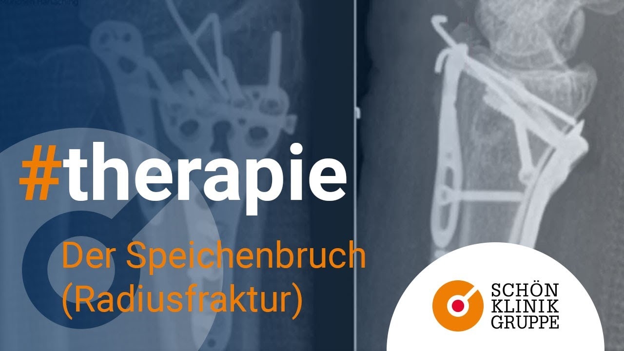 The broken spoke (radius fracture) | Schön Klinik München Harlaching