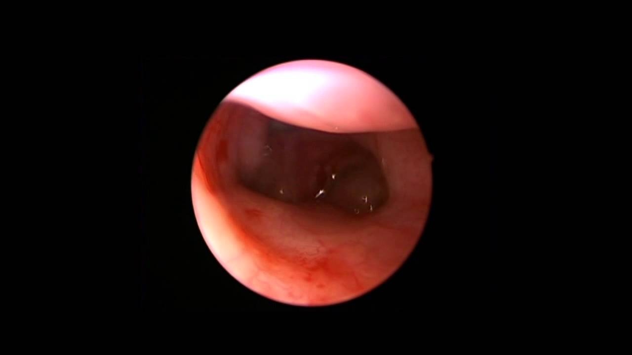 Balloon dilatation of the cochlea