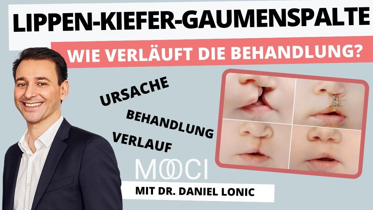 How to treat a cleft lip palate? | 9 questions to Dr. Daniel Lonic | MOOCI