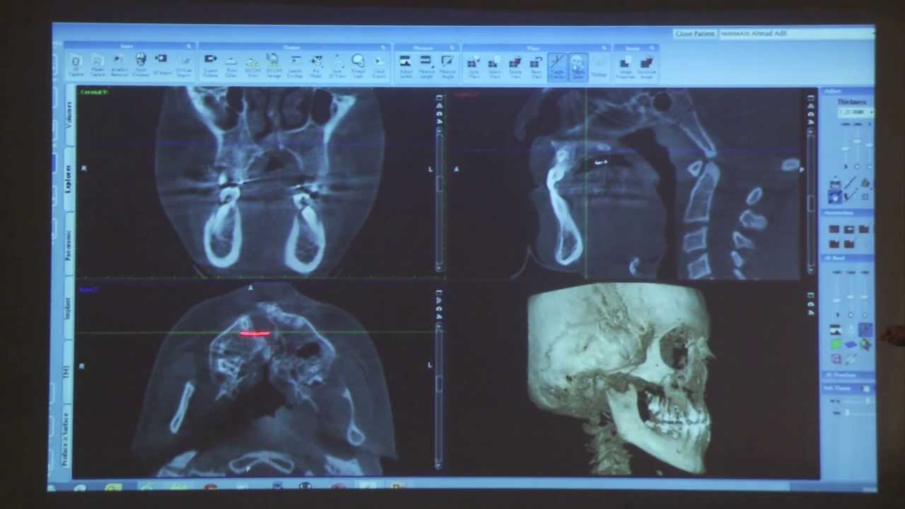 Clinical CBCT cases Prof Max Heiland