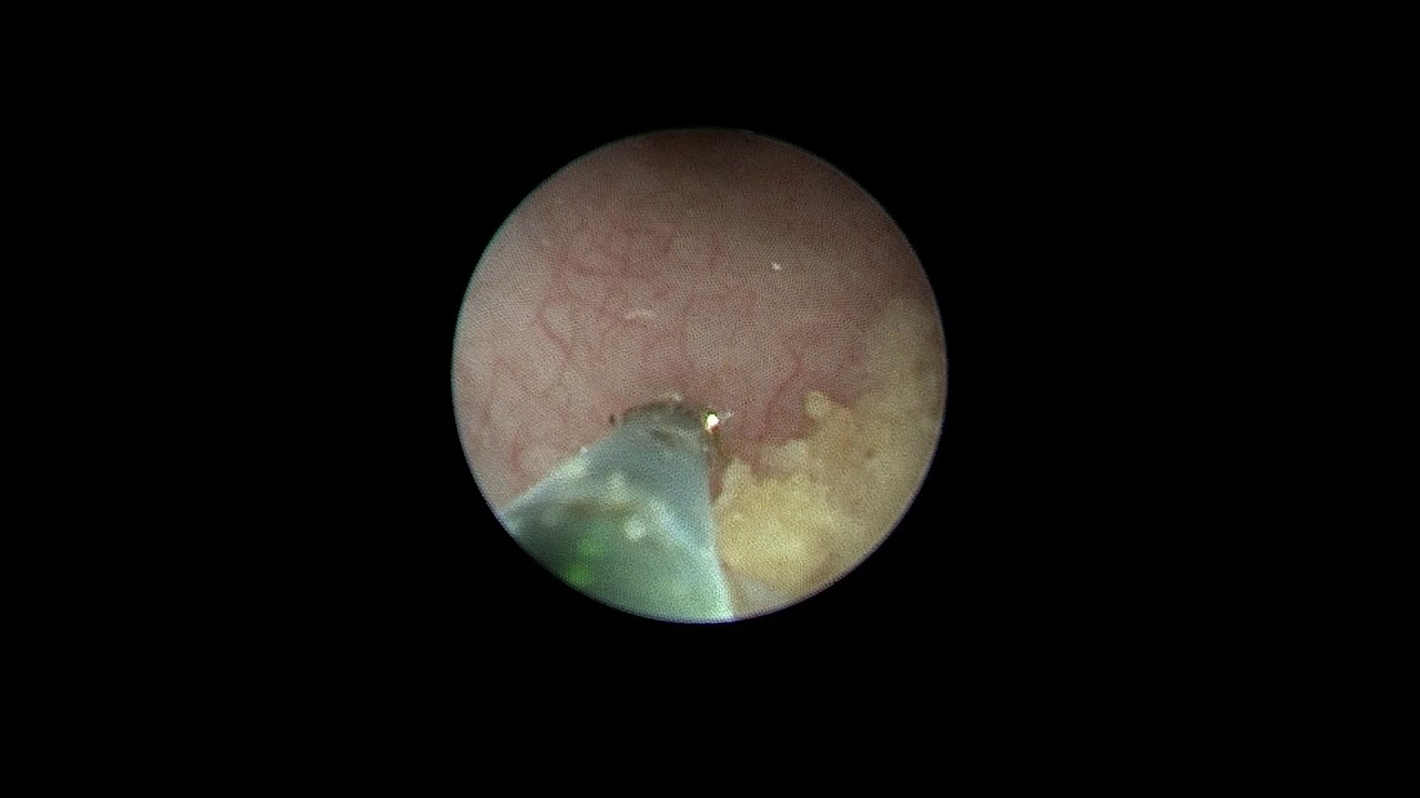 Laser Stone Breaking