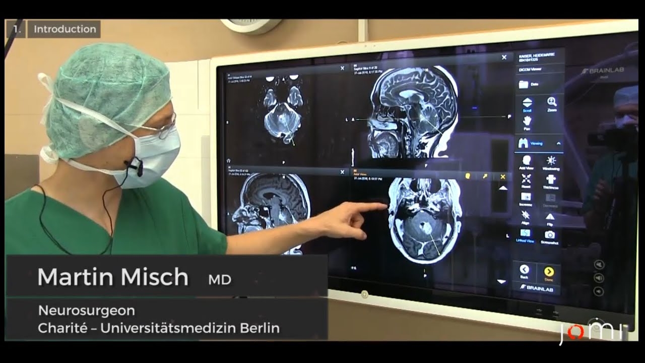 Brain Biopsy of a Suspected Cerebellar Lymphoma by Martin Misch Dr. med. (Links to Full Procedure)
