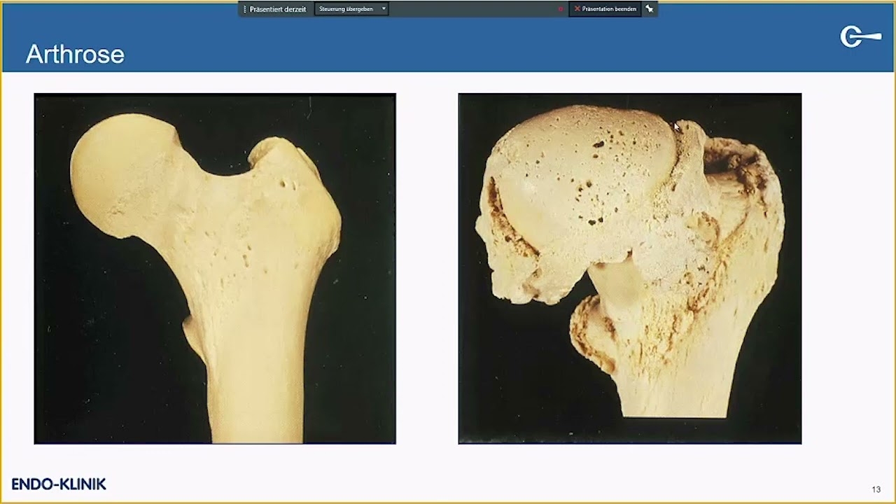 Presentation: “Hip Arthrosis — Treatment and Endoprosthetics” — Dr. Hans Mau, Chief Physician