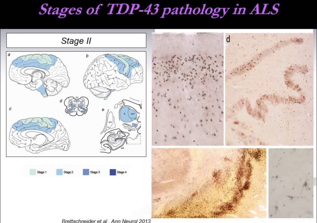 Professor Albert Ludolph (Germany) - ALSRG Milan 2013