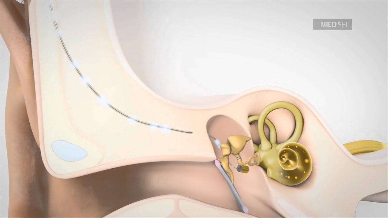 VIBRANT SOUNDBRIDGE Middle Ear Implant System for Hearing Loss Video | MED-EL USA