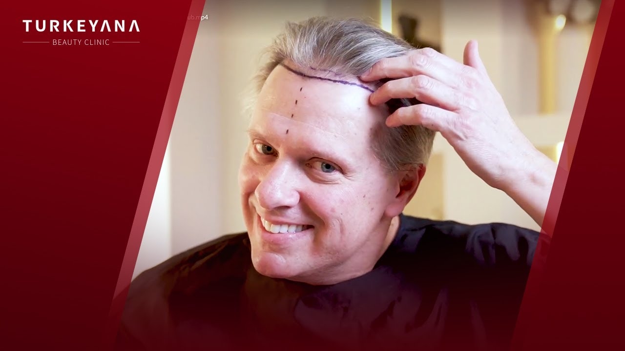 From the United States to Istanbul for a Hair Transplant | Full Experience and Patient Review