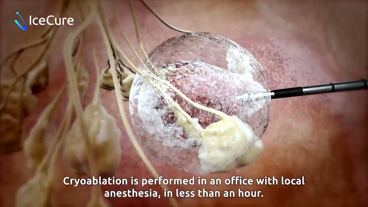 IceCure Medical's ProSense Cryoablation System