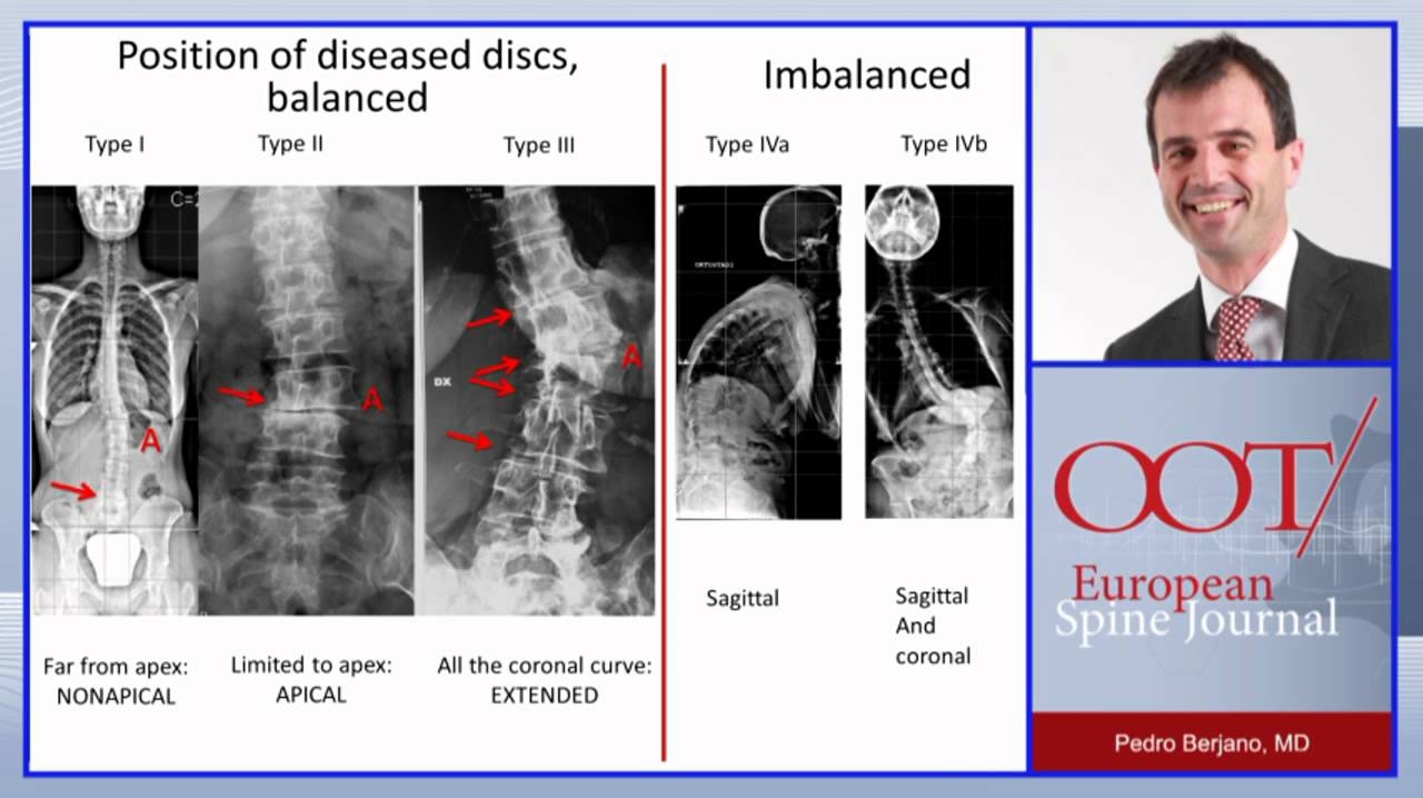 Lateral access surgery for adult deformity