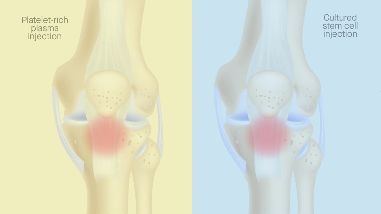 Cultured mesenchymal stem cells to treat patellar tendinopathy