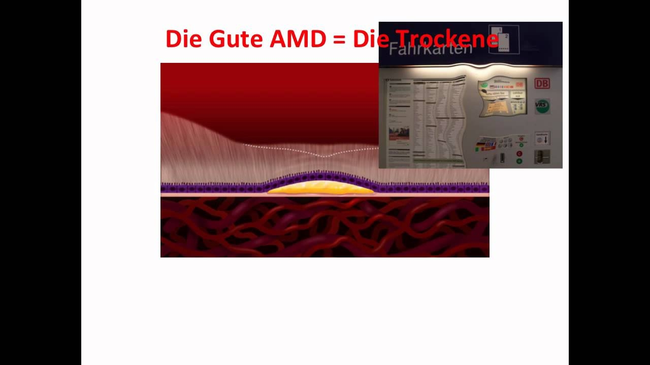 The new widespread disease macular degeneration? Causes and current methods of treatment