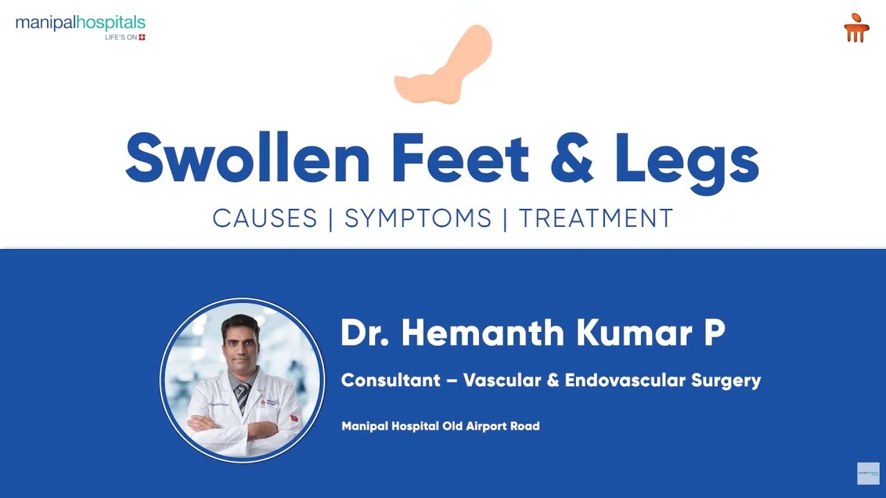 Swollen Feet & Legs|Dr. Hemanth Kumar Pandharpurkar | Manipal Hospital Old Airport Road