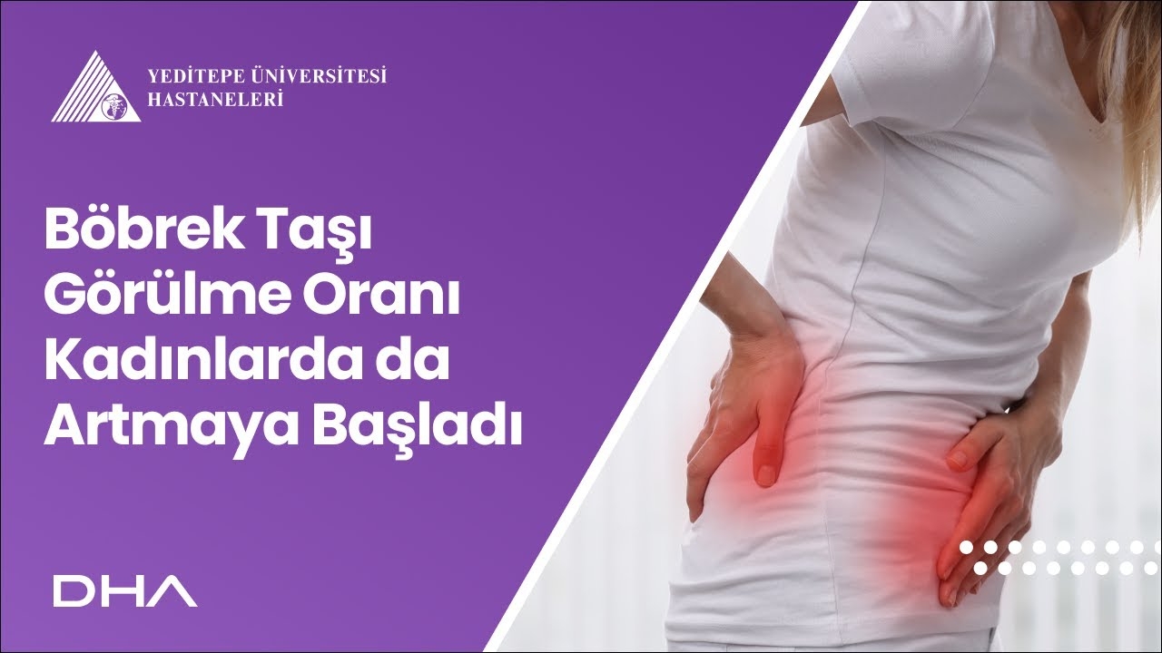 The incidence of kidney stones has also begun to increase in women