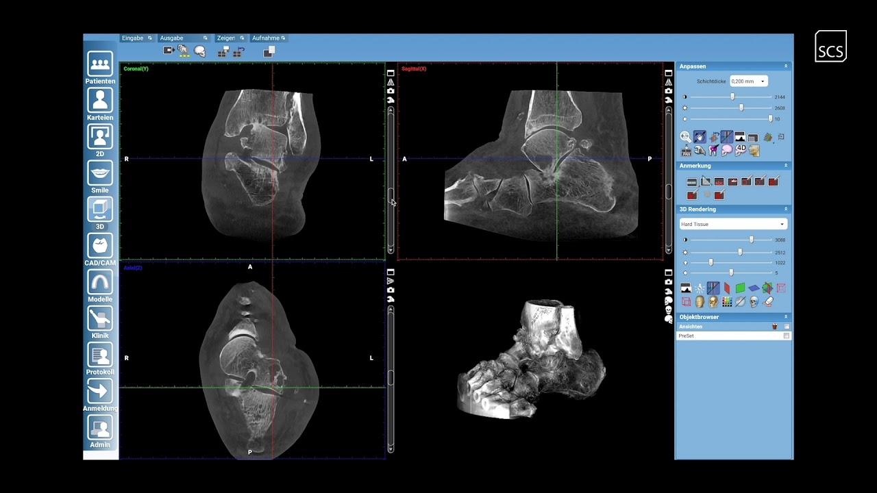 SCS | Society | Dr. med. Markus Preis | Case 2 | Preoperative Diagnosis | Ankle Prosthesis