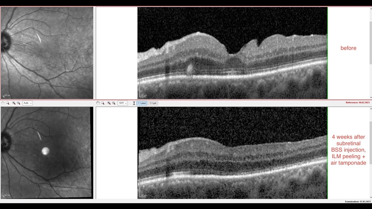 case report | retinal macrofolds after retinal detachment surgery