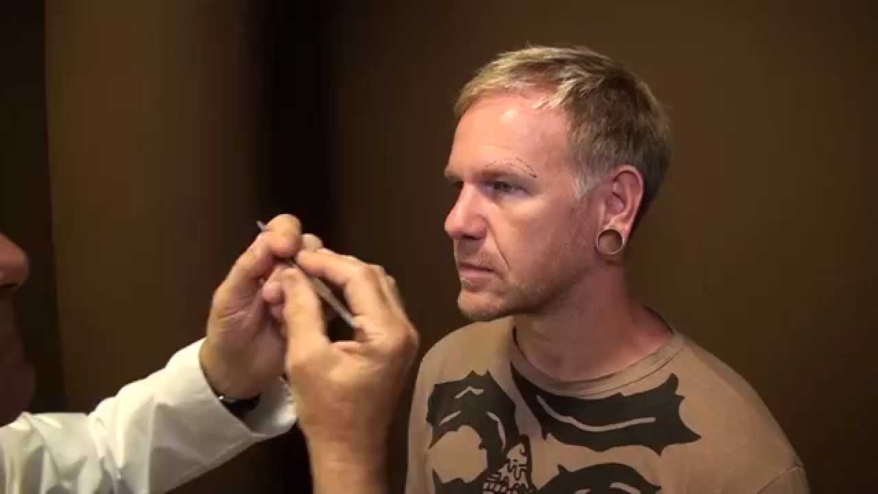 Elevation - Eyebrows and forehead surgery