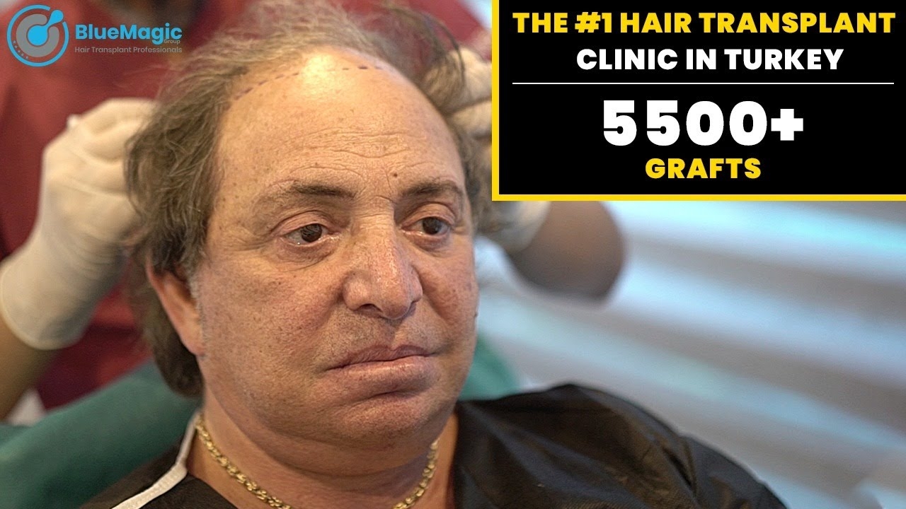 BEST HAIR TRANSPLANT CLINIC TURKEY | DHI- CHOI | 5000 GRAFTS | BlueMagic Group Clinic