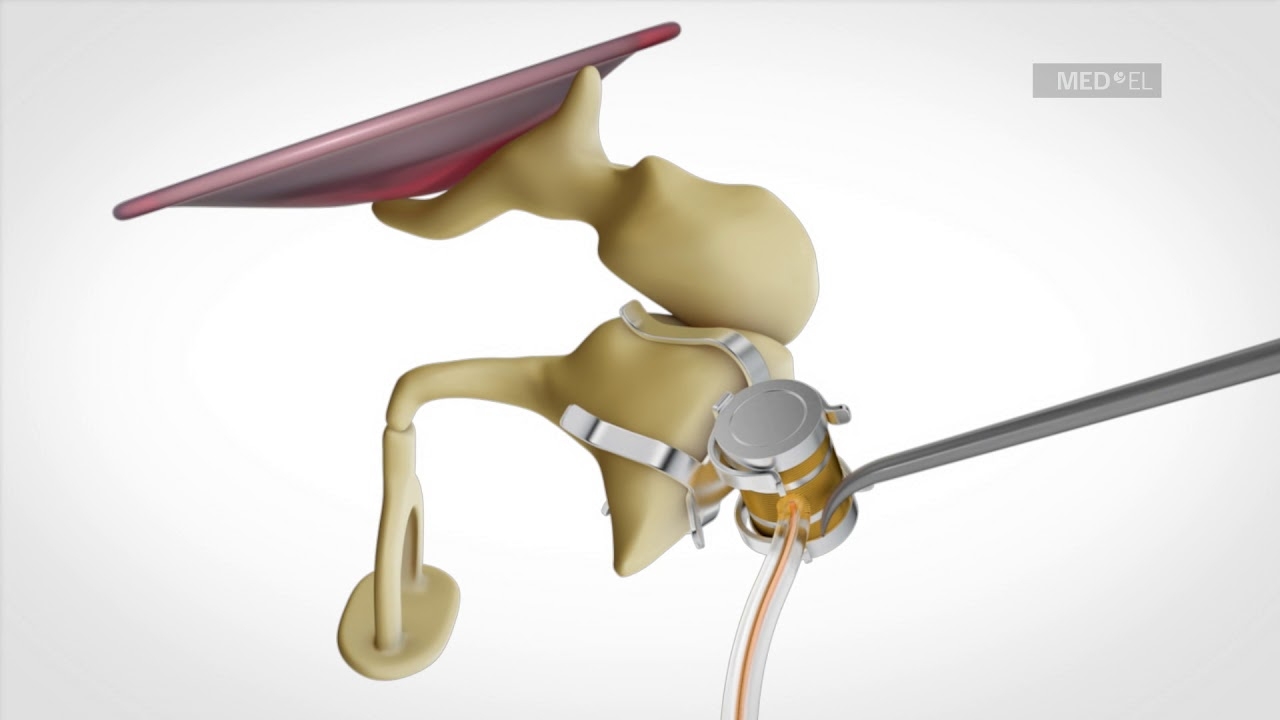 Using Vibroplasty Couplers with the VIBRANT SOUNDBRIDGE Middle Ear Implant (VORP 503)