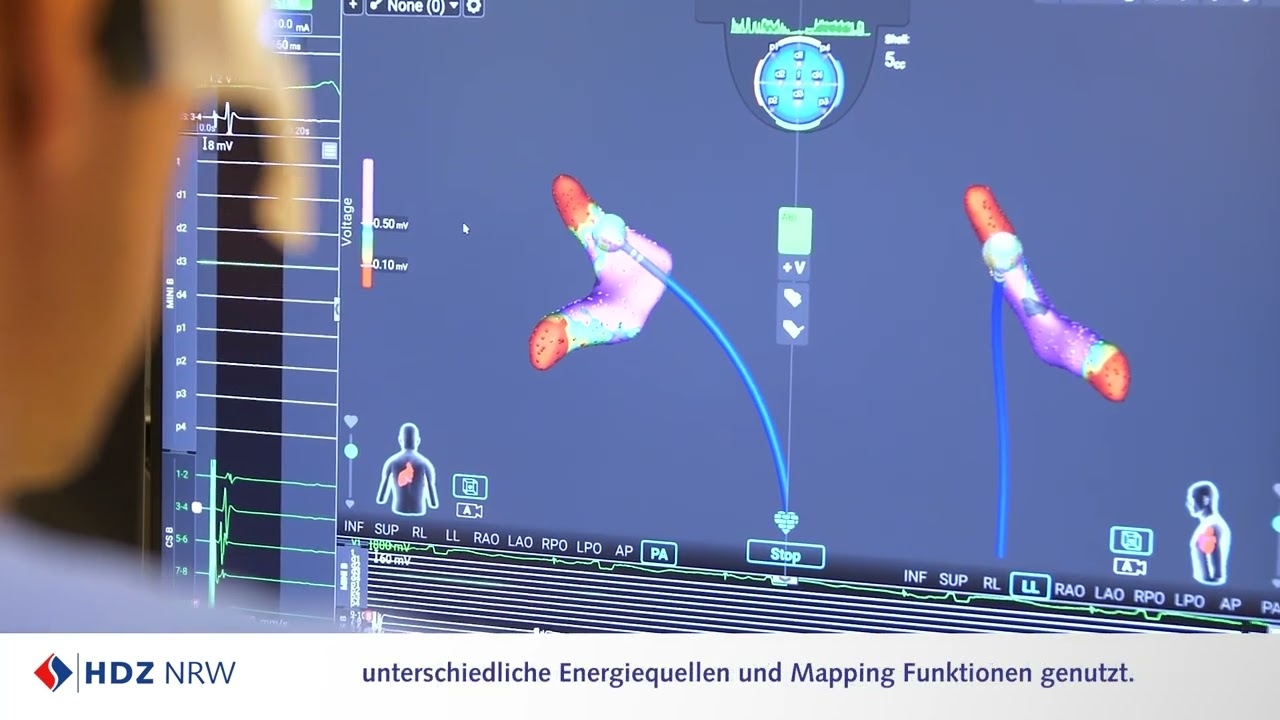 Atrial fibrillation: Specialists at HDZ NRW use novel ablation technology