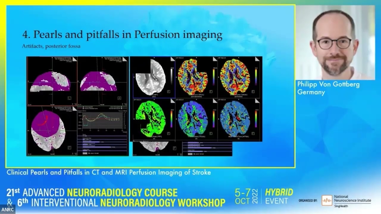 Clinical Pearls and Pitfalls in CT and MRI Perfusion Imaging of Stroke - Philipp Von Gottberg