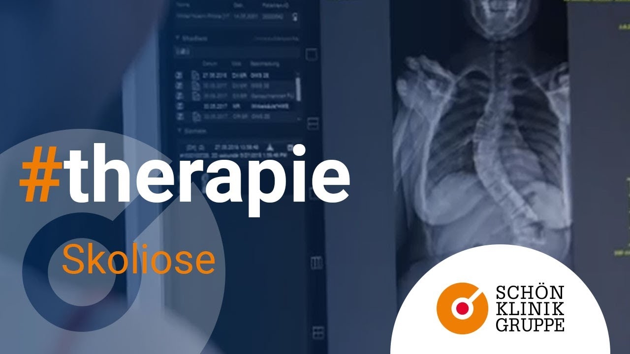 Scoliosis // Spinal Cord Pain Treatment. Schön Klink