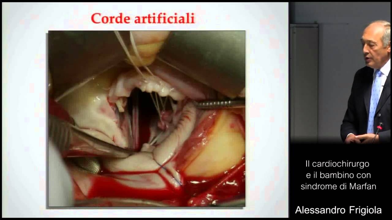 A. Frigiola - 8 Marfan Day 2014 - The heart surgeon and the child Marfan