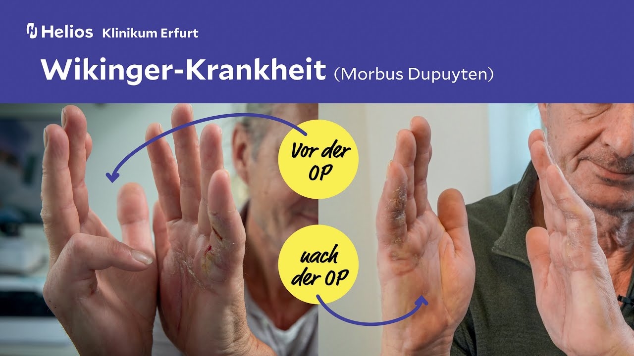 #Patientengeschichte: Viking disease (Dupuytren's disease)