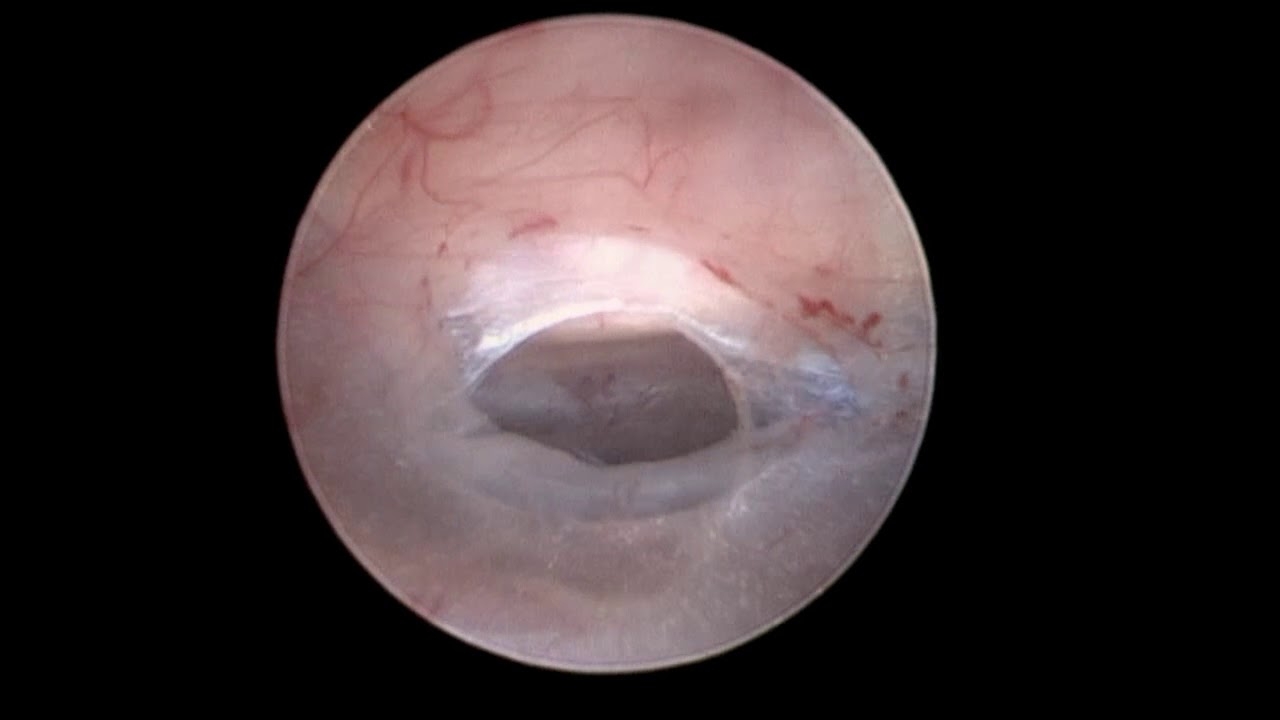 Third Ventriculostomy with the Little LOTTA® Ventriculoscope