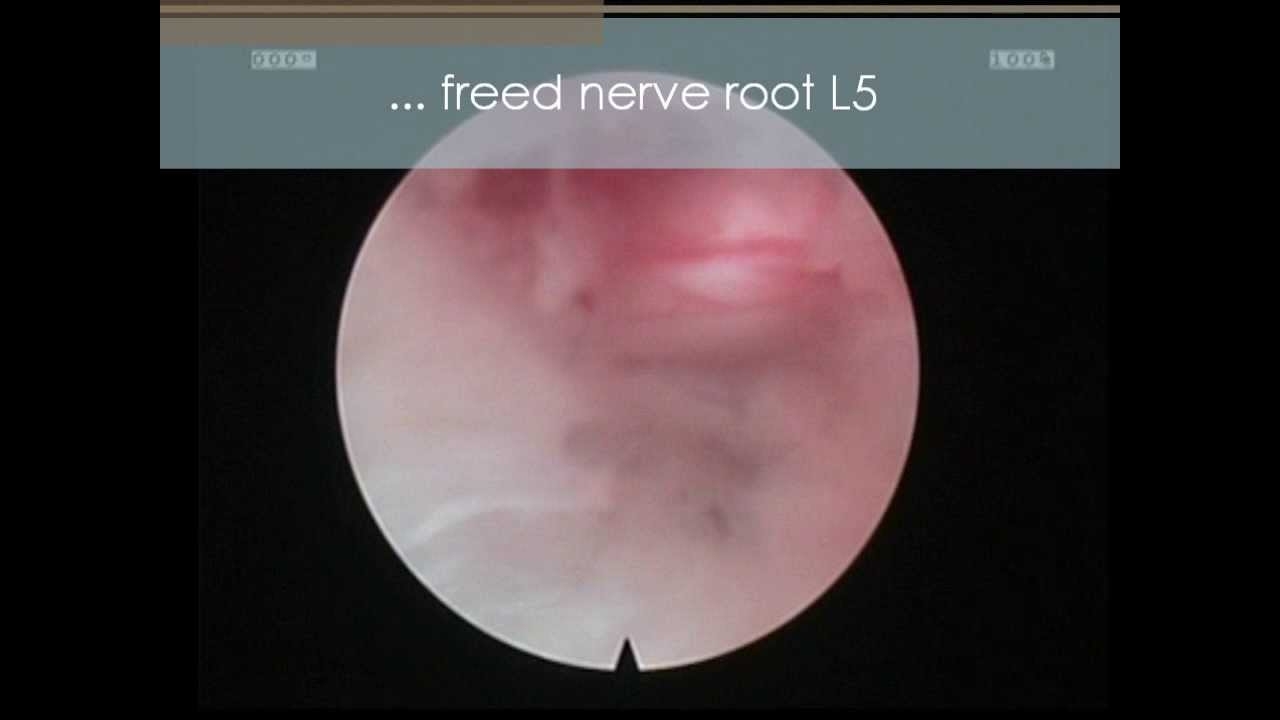 endoscopic intervertebral discs OP apex spine center