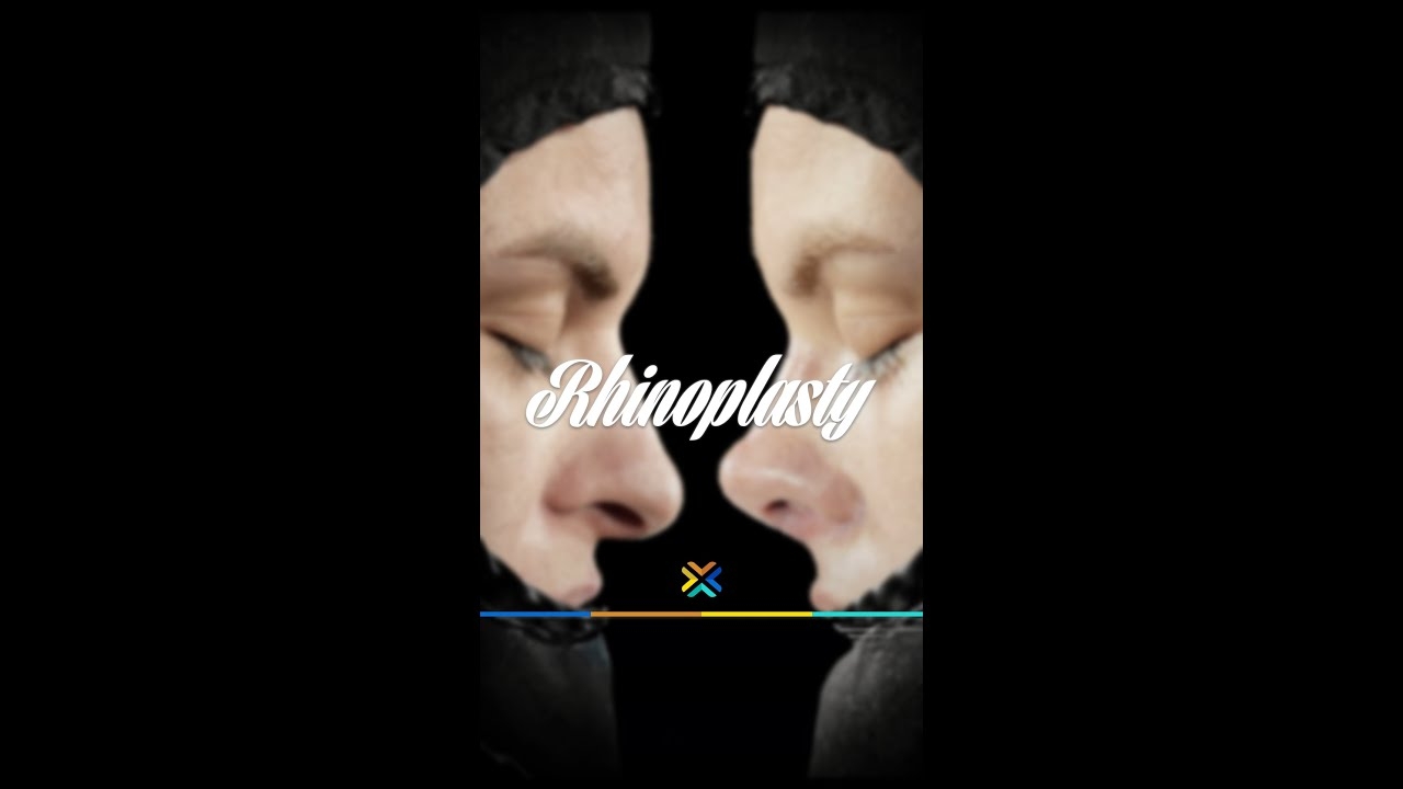 Rhinoplasty interview | #nose #nosejob #nosejobturkey #nosejobbeforeandafter #rhinoplastyresults