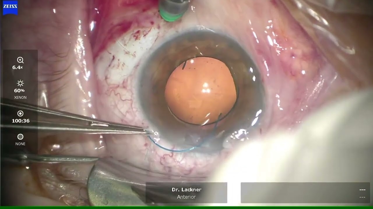 Refixation of a subluxated IOL with intrascleral Z-sutures