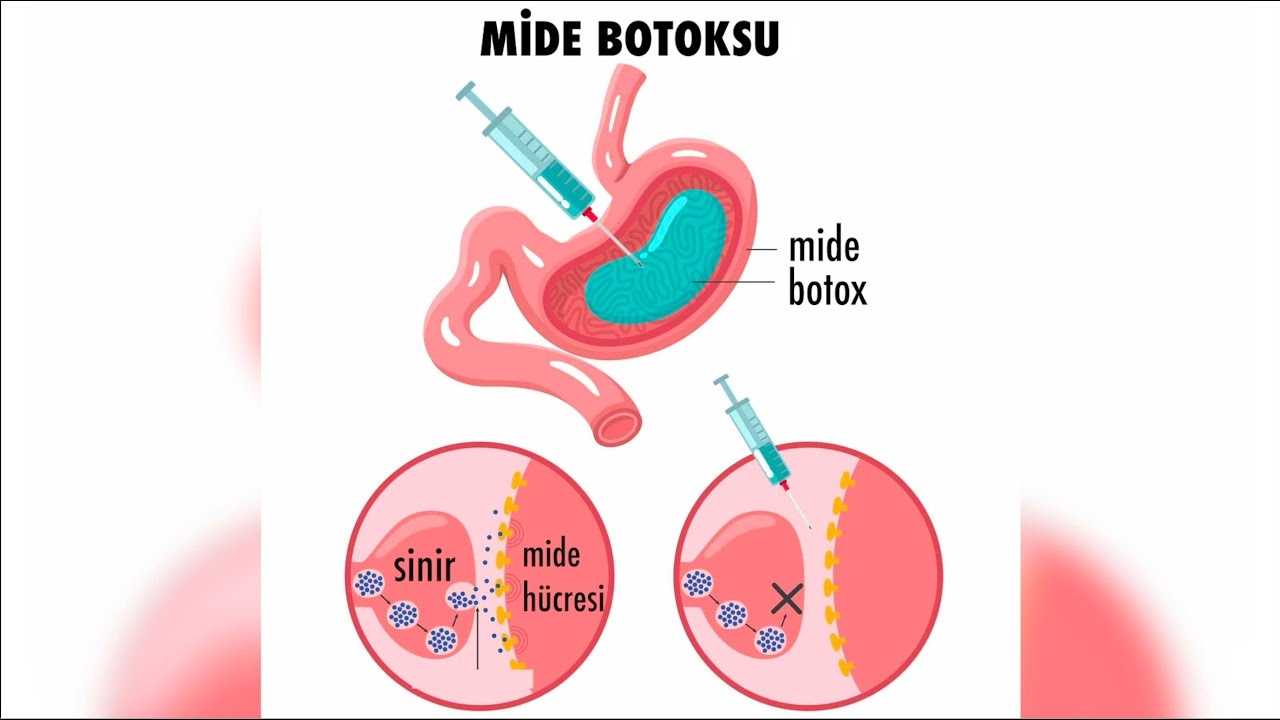 Stomach botox - what is a stomach bubble? - Prof. Dr. Alper Yurci (Gastroenterology Uz.)
